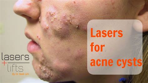 Treating acne cysts - YouTube