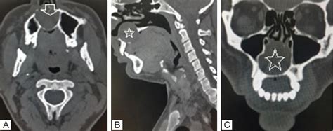 Non-odontogenic hard palate cysts with special reference to globulomaxillary cyst