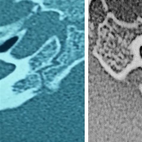 Shows a malformed cochlea, deficient modiolus and deficient lamina... | Download Scientific Diagram