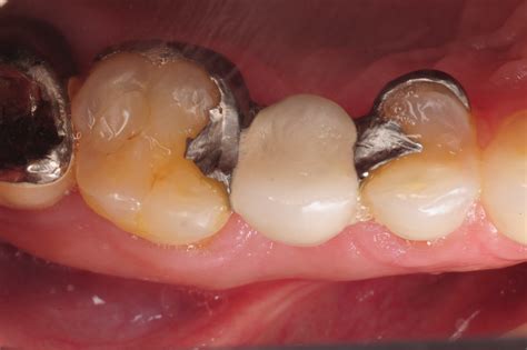 Maryland Bridge Conversion to an Implant-Supported Crown | Maryland ...