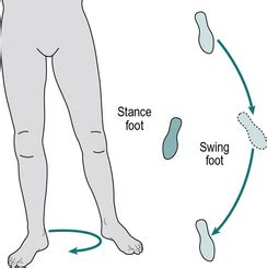 CIRCUMDUCTION GAIT PDF