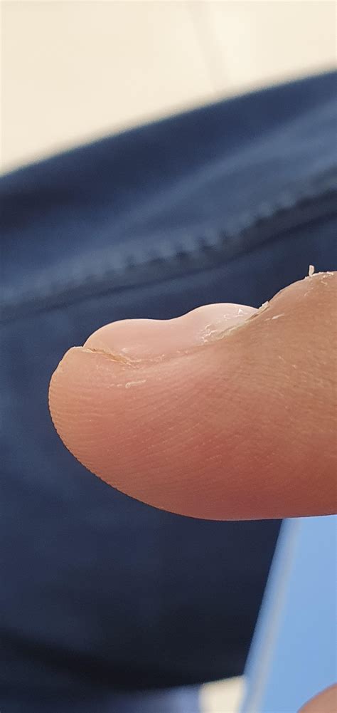 Finger has a dent growing on it everytime the fingernail grows out. : DiagnoseMe