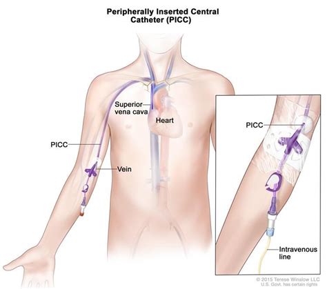 Peripherally Inserted Central Catheter (PICC): a thin, flexible tube that is inserted into a ...