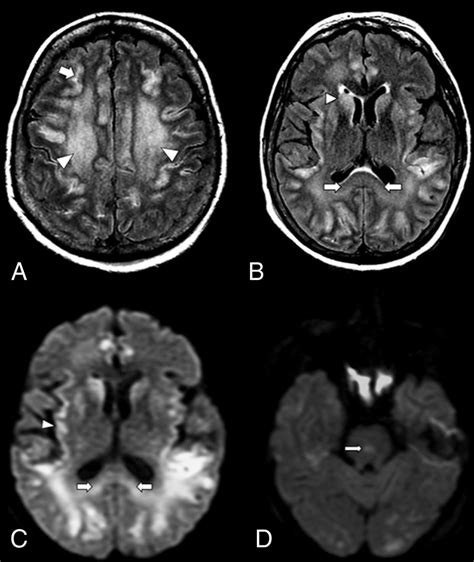 Imaging Features of Acute Encephalopathy in Patients with COVID-19: A ...