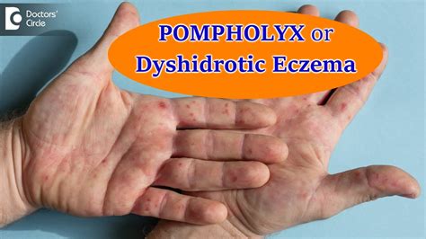 DYSHIDROTIC ECZEMA OR POMPHOLYX: Causes,Symptoms, & Treatment - Dr ...