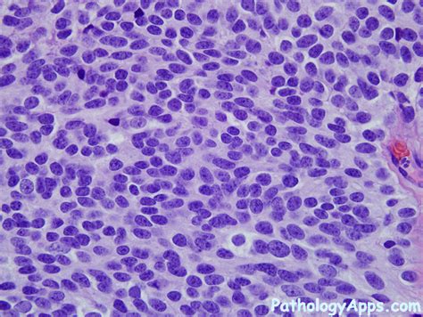 olfactory neuroblastoma pathology