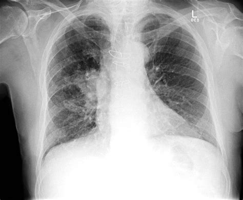 Pulmonary Nodules and Masses | Chest X-Ray - MedSchool