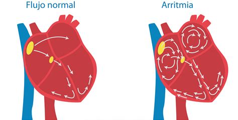Las arritmias cardíacas, factores de riesgo y principales tipos — Dr. Roberto Arregui ...