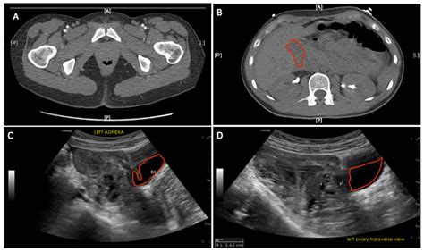 Cureus | A Case of Hemorrhagic Ovarian Cyst Rupture Necessitating Surgical Intervention