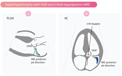 Hypertrophic Cardiomyopathy (HCM) & Hypertrophic Obstructive ...