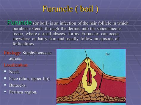 Boil skin infection pictures: Boils and carbuncles – Symptoms and causes