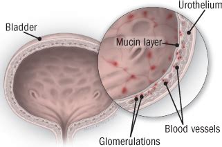 Cystoscopy and Hydrodilatation — Gold Coast Urology