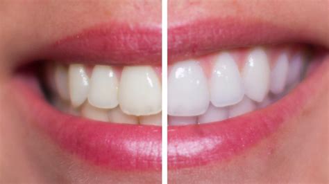 Hydrogen Peroxide Teeth Whitening - ToothStars