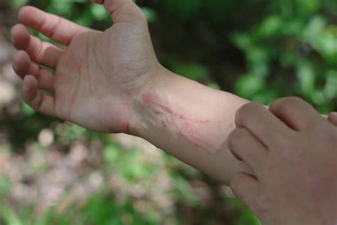 How to Treat a Poison Ivy Rash at Home | Amory Urgent Care