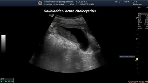 Acute Cholecystitis 02 [1 image] – EFSUMB