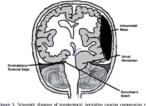 Kernohan-Woltman notch phenomenon: a review article. | Semantic Scholar