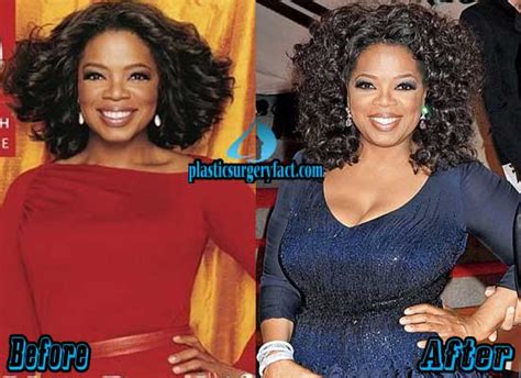 Oprah Winfrey Plastic Surgery Before and After Photos