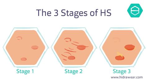 The stages of Hidradenitis Suppurativa - YouTube