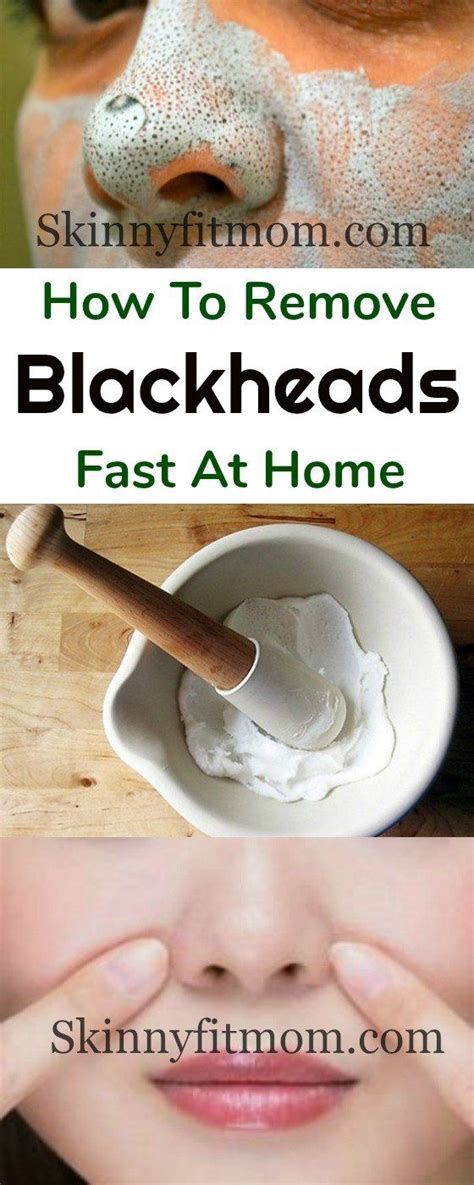 12 Best Home Remedies for Blackheads That Works | Hairstyles | Blackhead remedies, Acne remedies ...