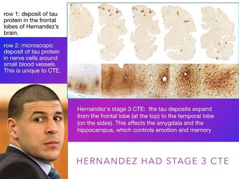 Aaron Hernandez - CTE Brain Injury - Murder Defenses - Criminal Law - 70 Slides | Teaching Resources