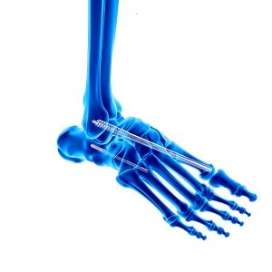 Charcot Foot Reconstruction Aurora IL | Charcot Foot Surgery Yorkville IL