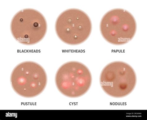 Acne types on dark skin, face pimples and comedones, vector blackheads and pore cysts. Skin acne ...