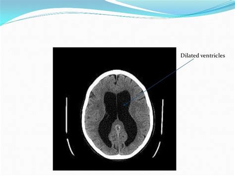 Hydrocephalus