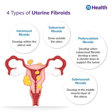 Uterine Fibroids Symptoms, Causes, Complications And, 40% OFF