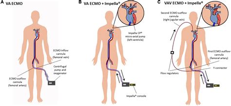 Frontiers | Case report: Refractory cardiac arrest supported with veno ...