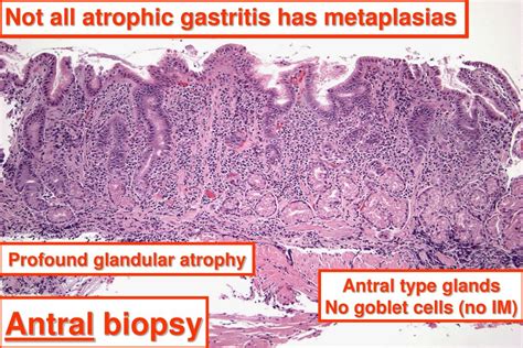 PPT - Atrophic gastritides PowerPoint Presentation, free download - ID:3391079