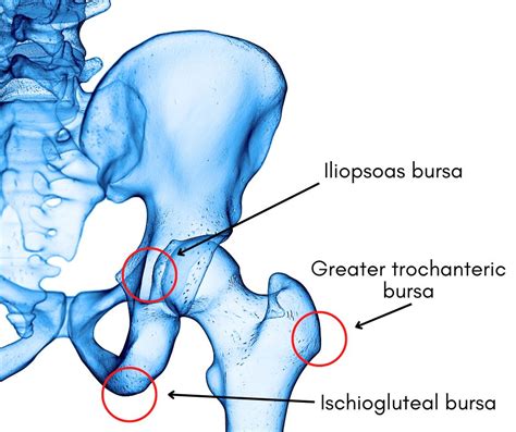 Hip Bursitis: Symptoms and Diagnosis