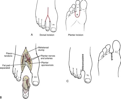 Amputation Toe Cpt Code