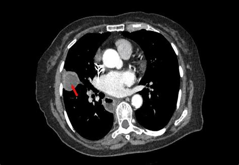 Cureus | Atypical Bronchial Carcinoid Tumor Revealed by Liver Biopsy