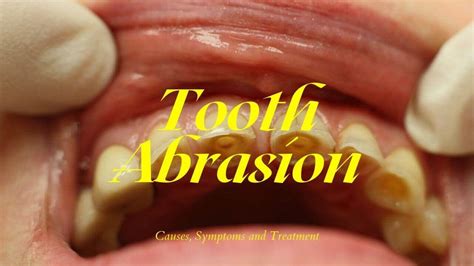 Tooth Abrasion: Causes, Symptoms And Treatment [Complete Explanation ...