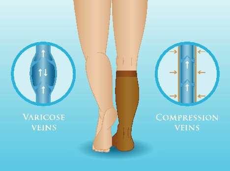 Compression Stockings Adelaide, SA | Deep Vein Thrombosis (DVT) Norwood, SA