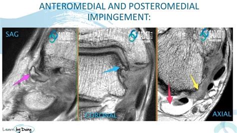 Antero Medial Ankle Impingement MRI - Radedasia