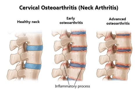 Cervical Osteoarthritis (Neck Arthritis) Treatment in NYC | New York Pain Care