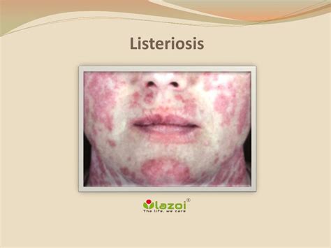 Listeria Symptoms