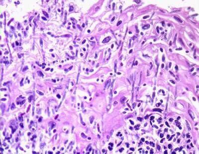 Candida Histology