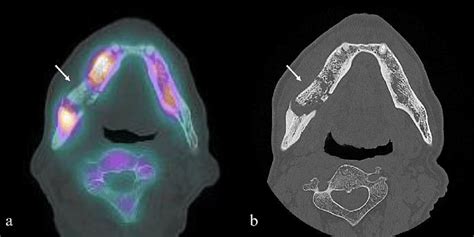 Findings of a "cold-inhot" region. a SPECT/CT image showing an ...