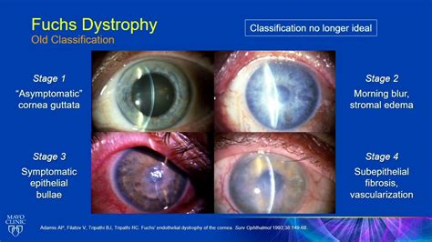 AIOC2020 GP008 T1 Dr Sanjay Patel Scheimpflug Imaging in Fuchs’ Endothelial Corneal Dystrophy ...