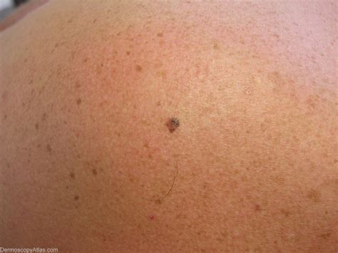melanoma symptoms images - pictures, photos