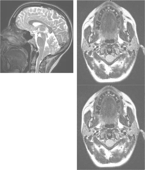 Patient 1. Chiari I malformation causing secondary cough headache. The... | Download Scientific ...