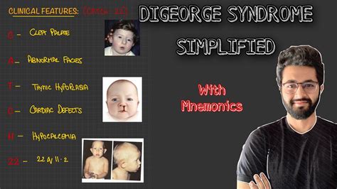 DiGeorge Syndrome || Deletion Syndrome || Immunodeficiency , 54% OFF