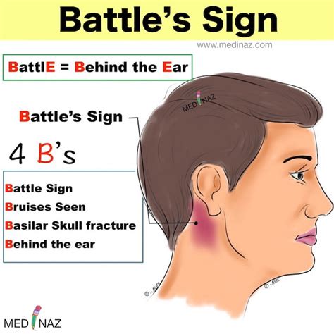 Battle's Sign USMLE Notes