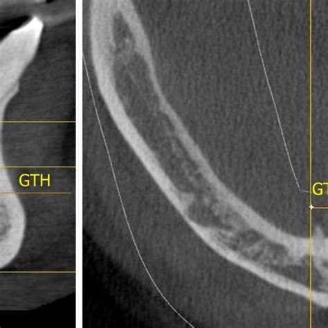 Measurements of the genial tubercle height, distance from the superior ...