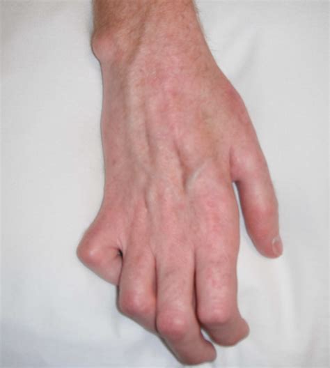 Claw hand causes, signs, symptoms, diagnosis and claw hand treatment