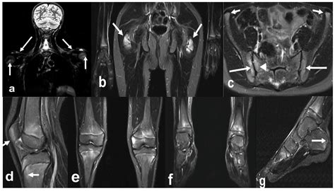 Biomedicines | Free Full-Text | Advances in Musculoskeletal Imaging in Juvenile Idiopathic Arthritis