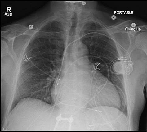 Chest x-ray demonstrating mild cardiomegaly with a dual-chamber ...