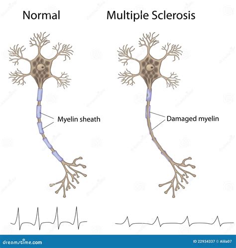 Multiple Sclerosis Royalty Free Stock Photography - Image: 22934337